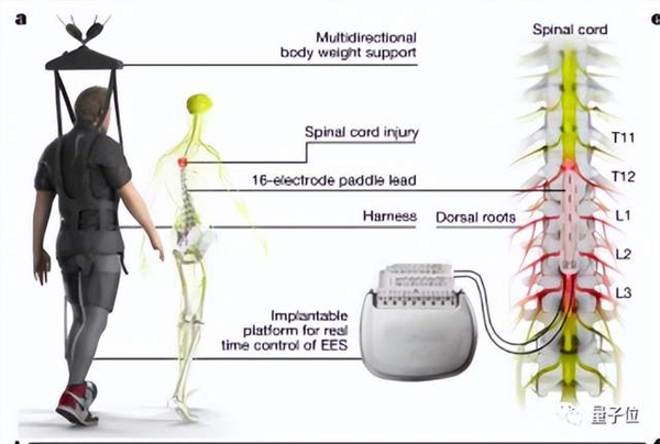 电刺激让瘫痪者重新行走原理找到了：3人已治疗成功
