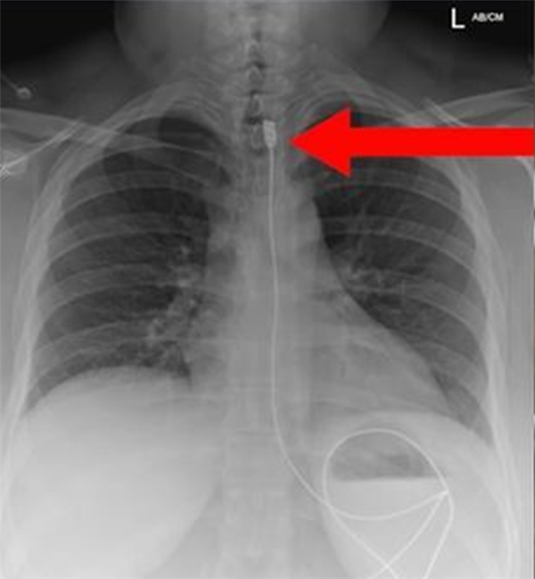 女子呼吸困难紧急就医 X光发现体内有1米长iPhone数据线