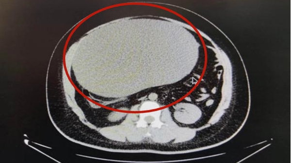 女子以为发胖肚中取出16斤囊肿 比足球还大！